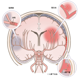 脳梗塞・脳出血・くも膜下出血